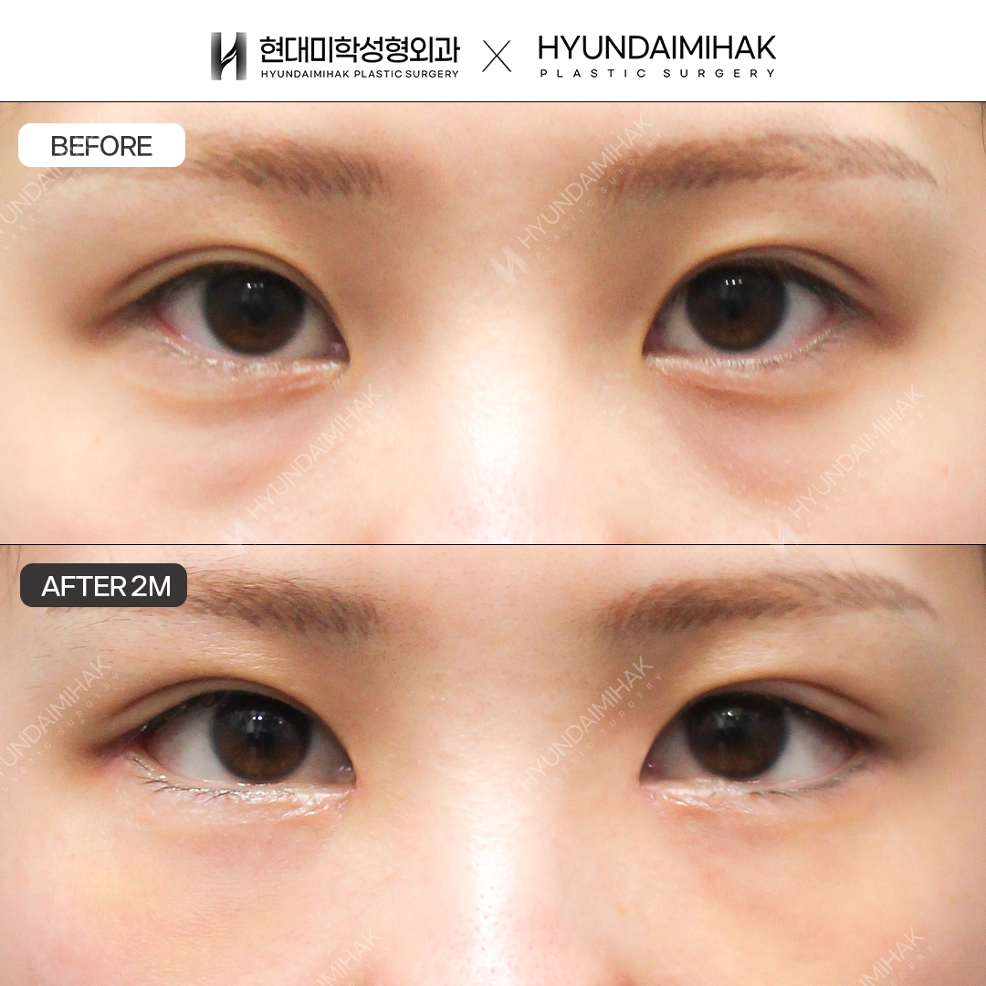 Dual Canthoplasty + Under-Eye Fat Repositioning