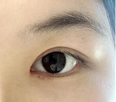 I brought my eye surgery review ^q^