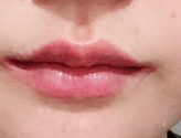One-month review after mouth-corner surgery