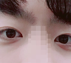 I Had Incisional Double-Eyelid Surgery