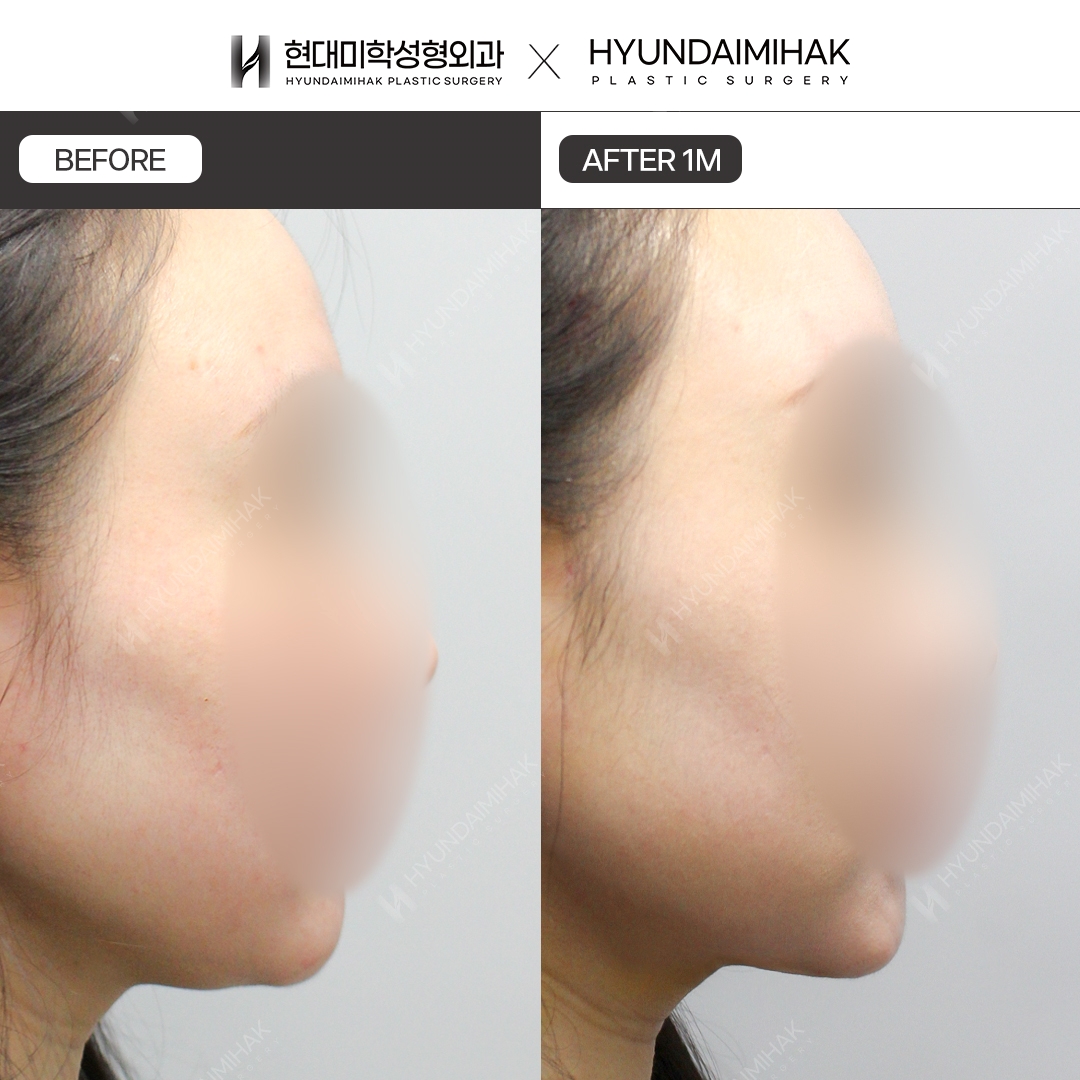 Double Chin Thread Lift, 1 Month