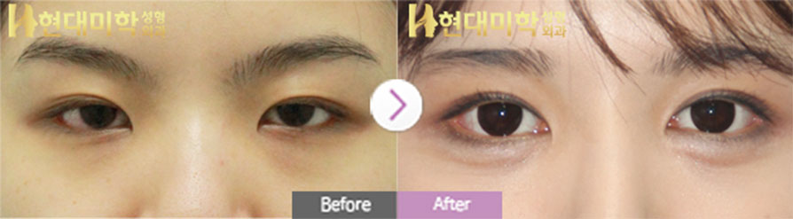 Non-Incisional Method, Inner and Outer Canthoplasty