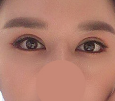 One month after revision eye surgery lol, this is a success, right?? ^^