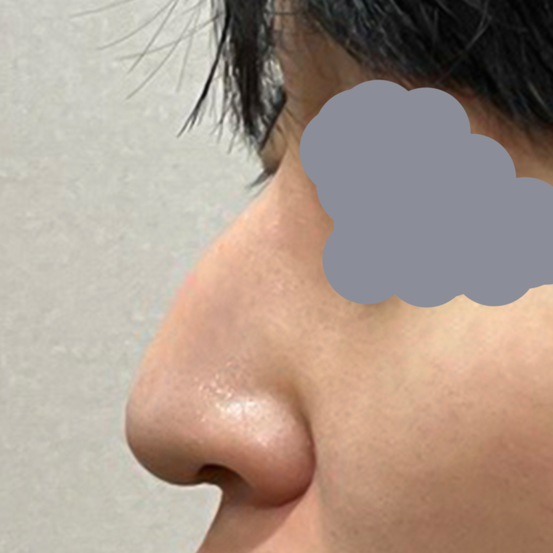 Male hump-nose surgery