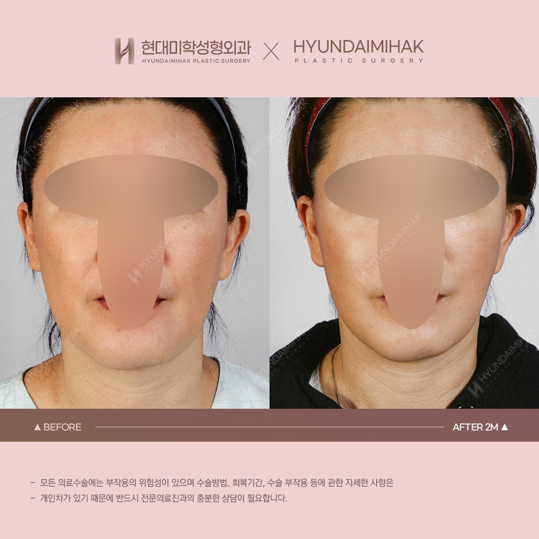 [Anti-Aging Surgery] Thread Lift, 2 Months