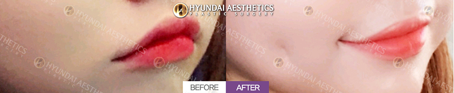 Mouth Corner Lift