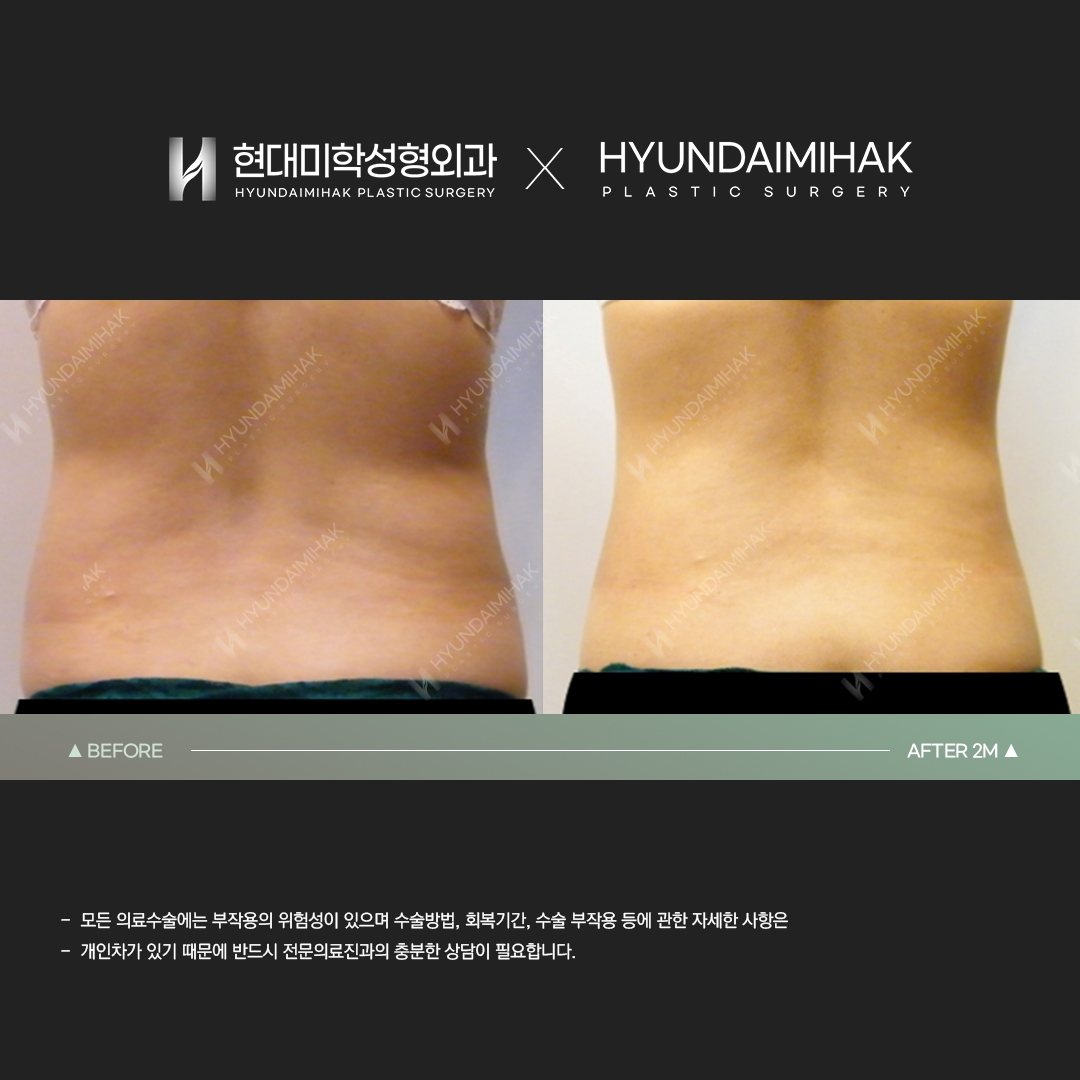 Abdominal liposuction, 2 months after surgery