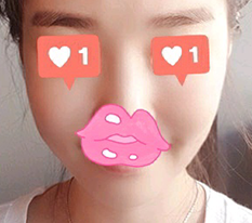 After cheekbone surgery I became so feminine!