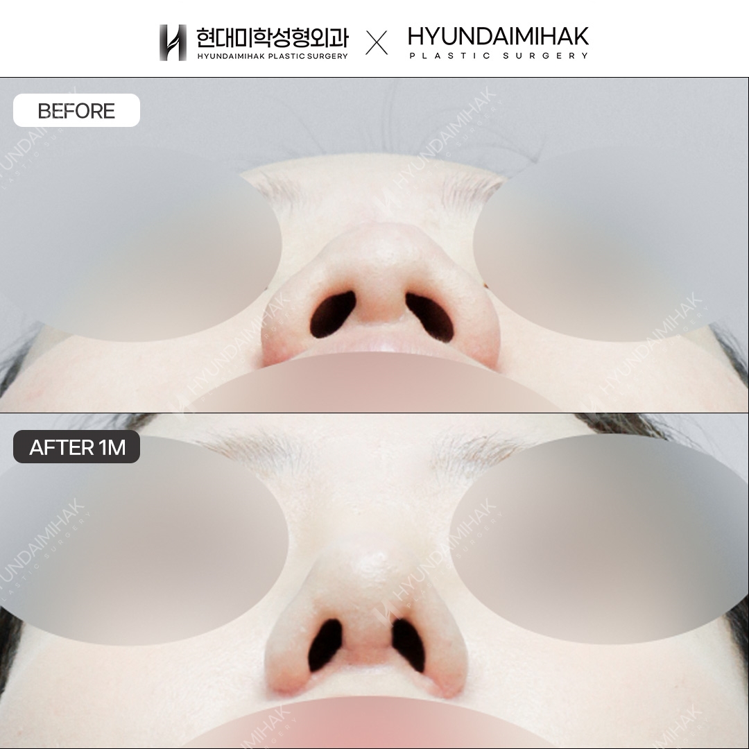 [Bulbous nose rhinoplasty] Nasal bridge + nasal tip, 1 month post-op