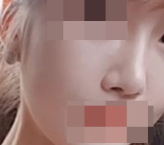 I had revision rhinoplasty :)