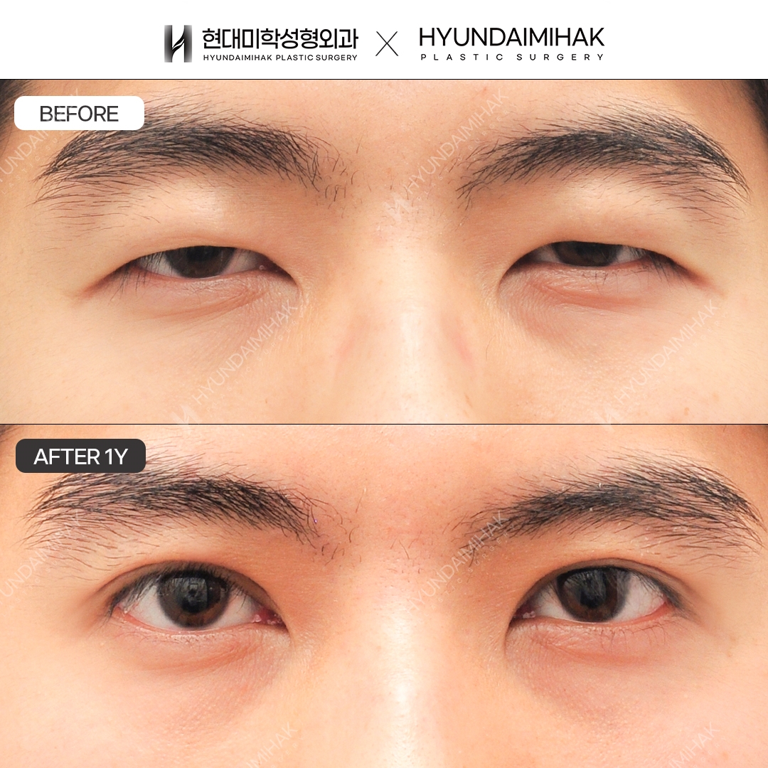 [Male Eye Surgery] Incisional Ptosis Correction