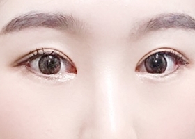 For eye surgery, go go to Hyundai Aesthetic Surgery~