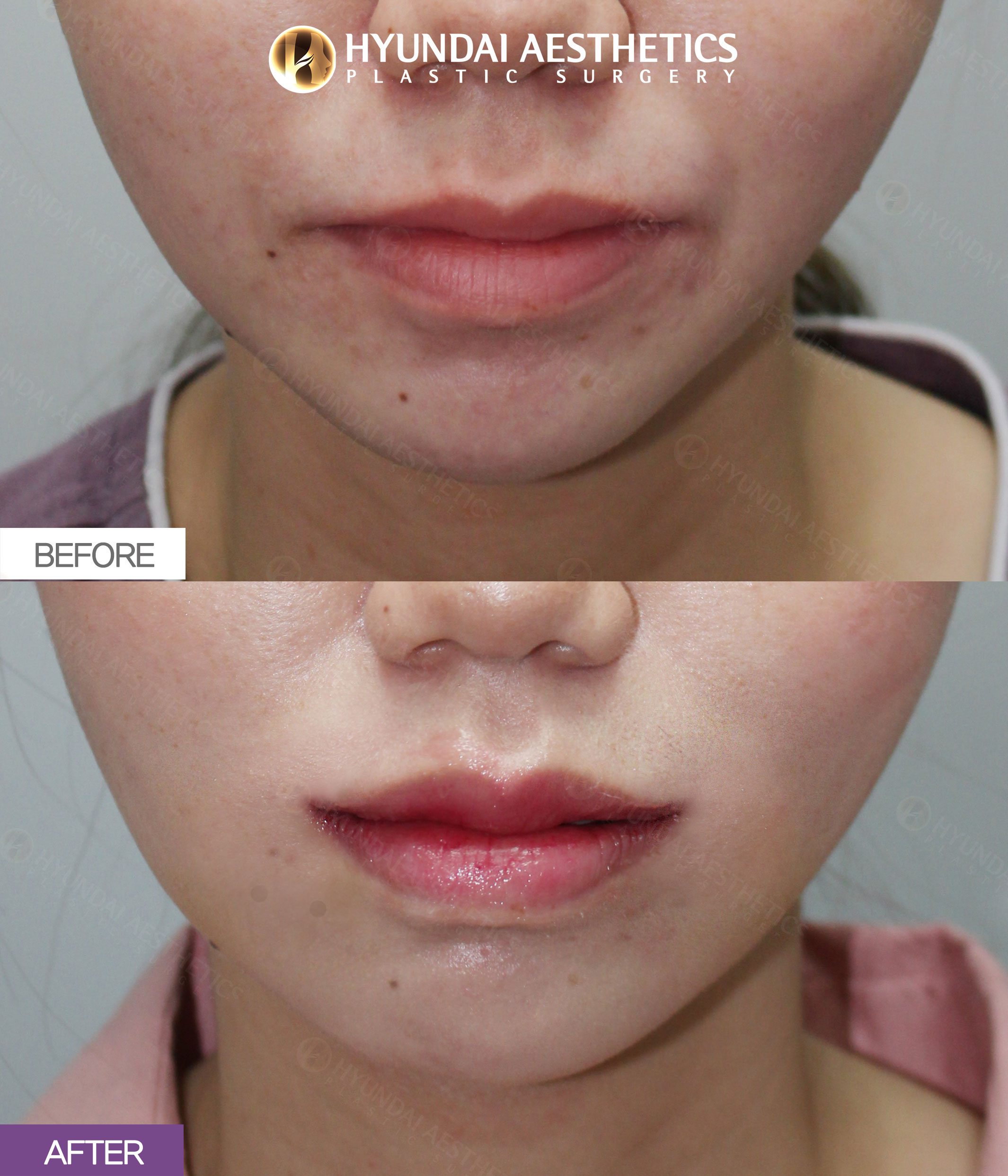 Lip Surgery, 1 Month
