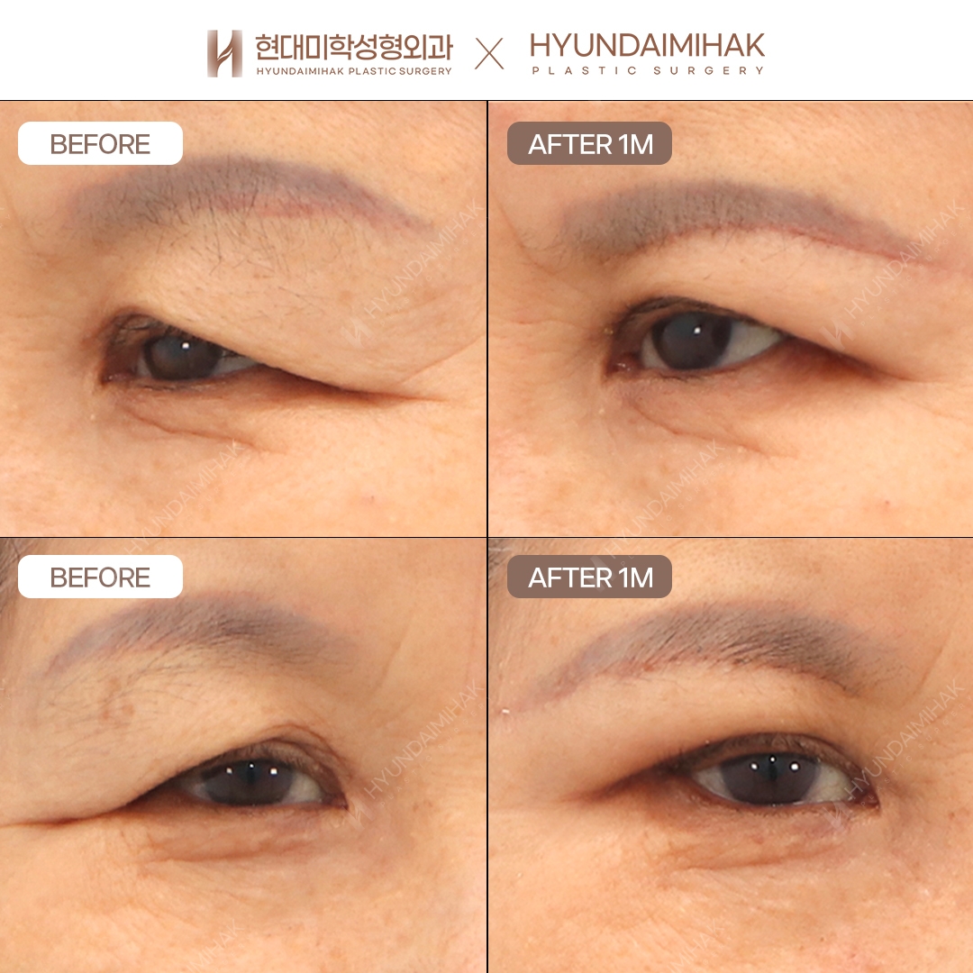 [Anti-Aging Surgery] Brow Lift, 1 Month
