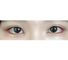I Highly Recommend Dual Canthoplasty