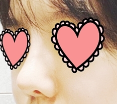 I am really satisfied with my revision rhinoplasty line!!
