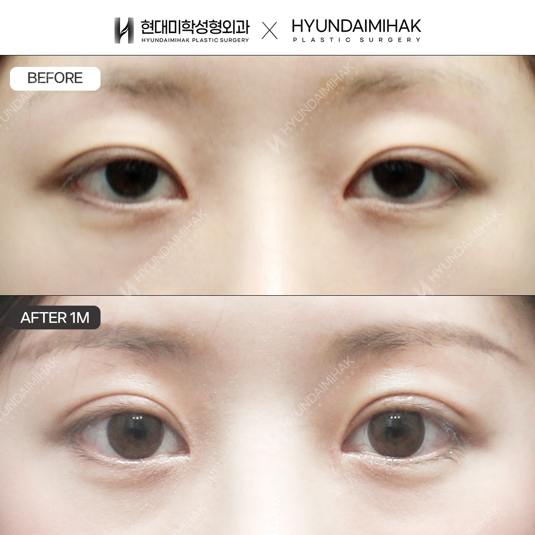 [Eye revision surgery] Non-incisional double eyelid surgery