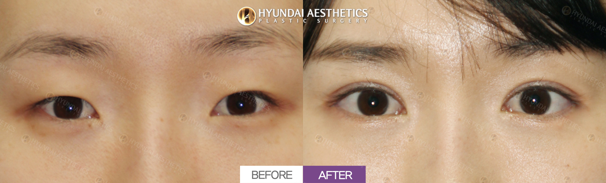 Incisional ptosis correction + epicanthoplasty + double eyelid surgery + lower canthoplasty + lateral canthoplasty