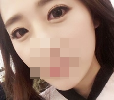 Highly recommend Hyundai Aesthetic Surgery eye-shape correction!~♥