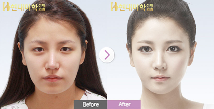 Eye Surgery, Nose Surgery, Double-Jaw Surgery