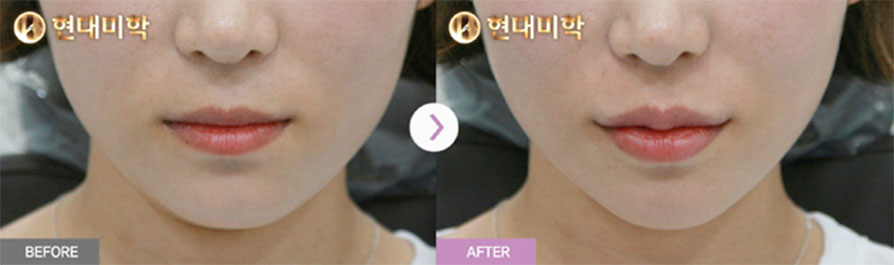 Lip Filler