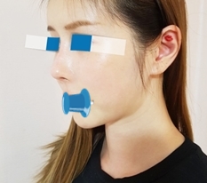 I was nervous for my first low-nose surgery