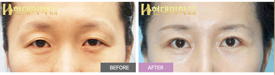 Upper Blepharoplasty, Epicanthoplasty, Lateral Canthoplasty, Lower Canthoplasty
