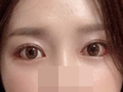 Got eye surgery~♥
