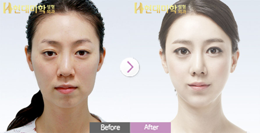 Ptosis Correction, Lower Canthoplasty, Rhinoplasty, Fat Grafting, Square Jaw, Cheekbones