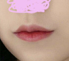 So satisfied with the shape and the scar from my corner lip lift haha
