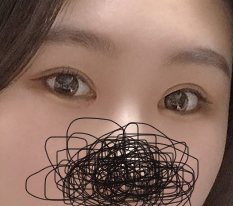 They really deserve the nickname canthoplasty specialist~ Hyundai Aesthetic Surgery is the best!