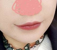 I posted a 2-month review after my lip corner surgery, and now that 3 months have passed I'm posting a 3-month one too ><
