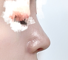 My First Nose Surgery
