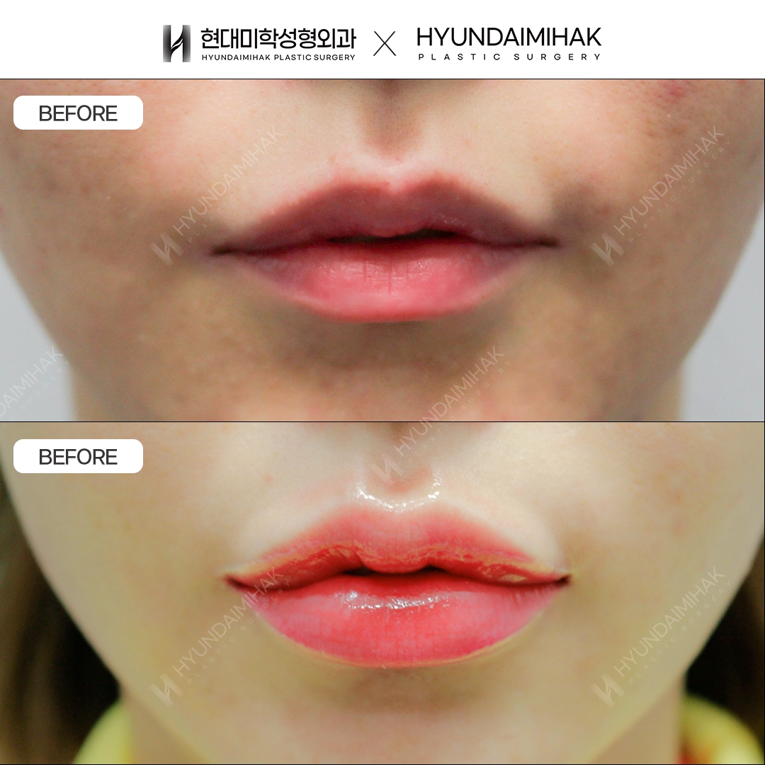 [Lip Surgery] Cupid's Bow Line and Asymmetry Correction, 1 Month