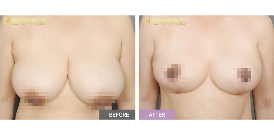 Breast Reduction Surgery