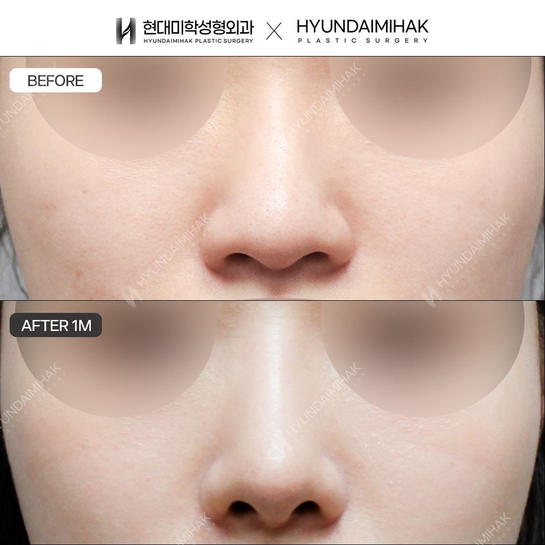 [Bulbous Nose Surgery] Bridge + Tip, 1 Month