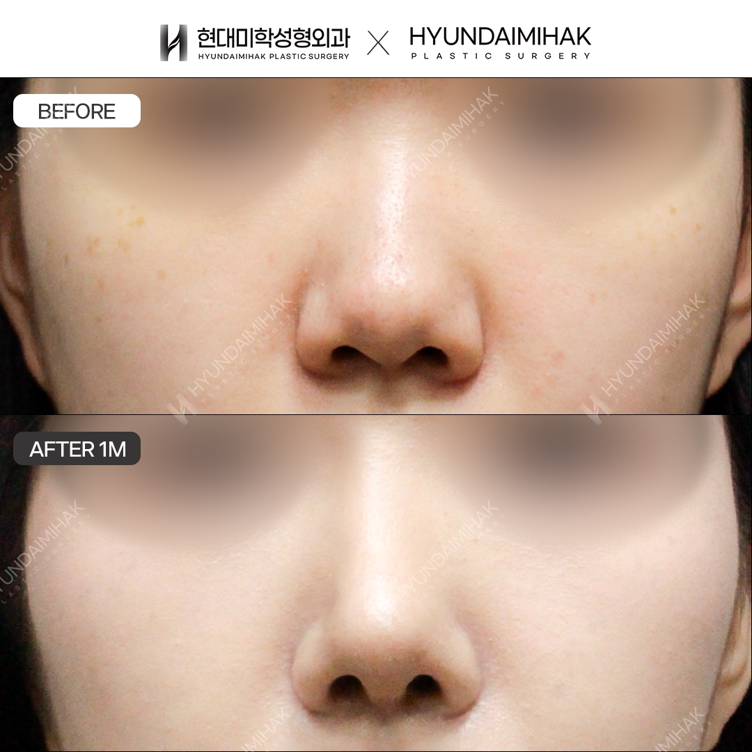 [Revision Rhinoplasty] Nasal bridge + nasal tip, 1 month post-op