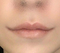 I think my lip corner surgery was a huge success haha