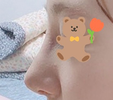 Posting my review on day 7 after nose surgery
