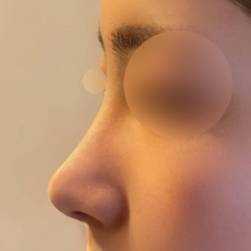 How I insisted on only nose-tip surgery for my first rhinoplasty, then ended up doing the bridge too