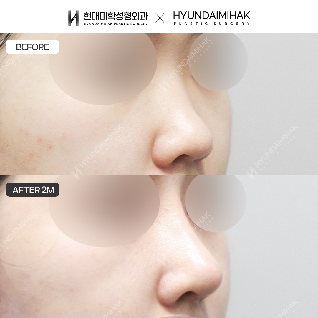 [Low nose rhinoplasty] Nasal bridge + nasal tip, 2 months post-op