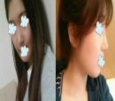 This is what rhinoplasty is all about!!