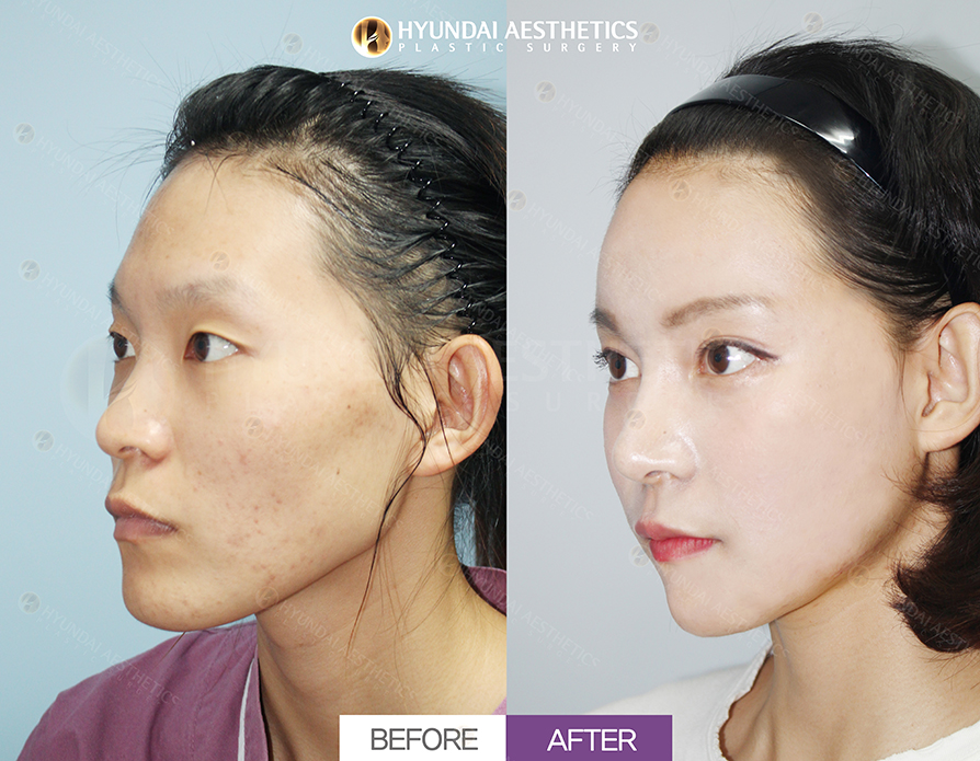 Cheekbone Reduction + Square Jaw Reduction + T Osteotomy