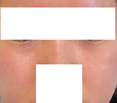 I got under-eye fat repositioning and my face looks lively lol