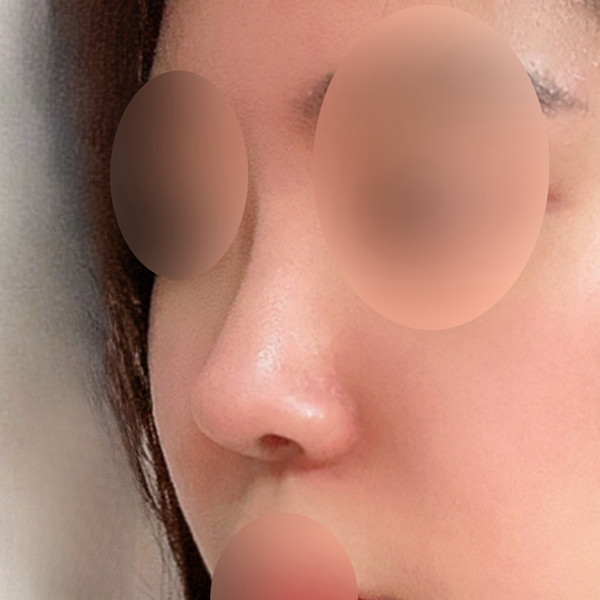 Natural first rhinoplasty~ Nose bridge, tip, and nostril reduction