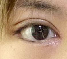 One week after eye revision surgery