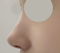 Review of hump-nose surgery + tip plasty