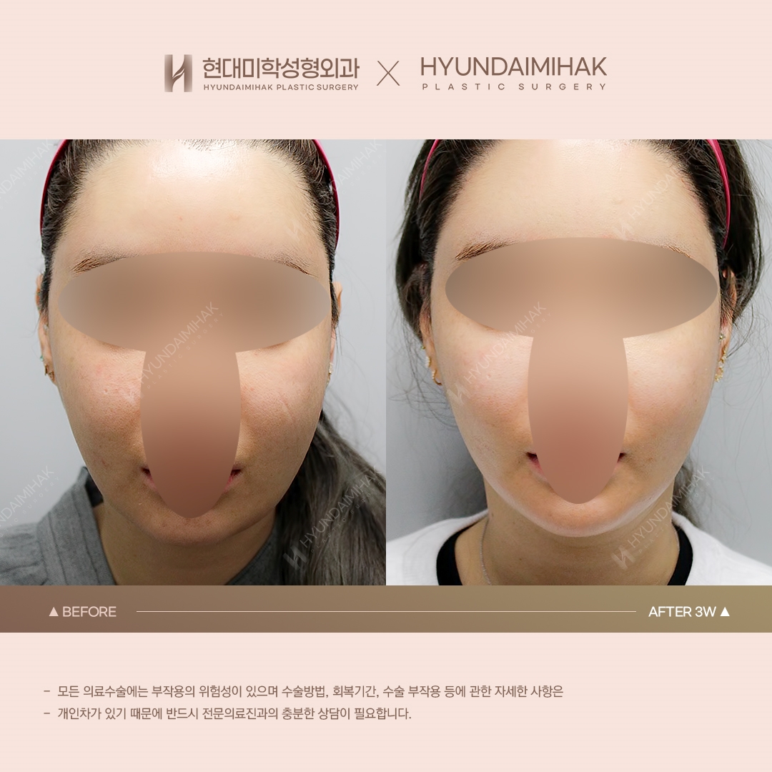 [Lifting] Double-Chin Thread Lift, 3 Weeks Later