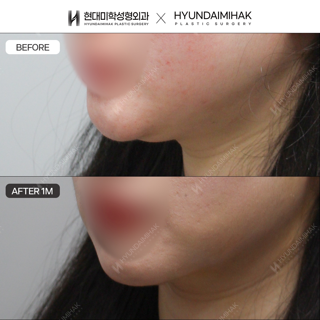 Double Chin Thread Lift, 1 Month