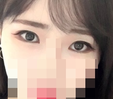 Totally satisfied with Hyundai Aesthetic Surgery eye-shape correction♥